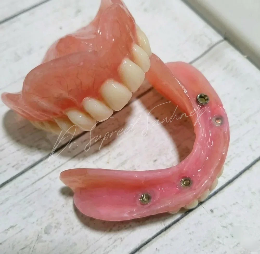 Complete maxillary denture and mandibular implant-retained overdenture with four attachment housings